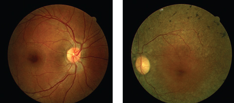 Can these fundus images help point to a diagnosis for this 44-year-old patient suffering from poor night vision?