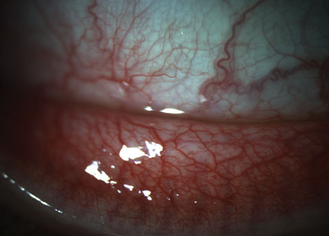 Fig. 4. This patient’s 3+ papillae at the inferior fornix could be visualized at both the slit lamp as well as on meibography.