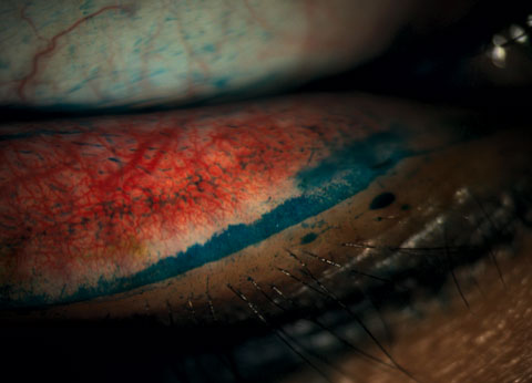 Fig. 5. Staining revealed lid wiper epitheliopathy in a patient with dry eye symptoms.
