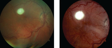 Figs. 1 and 2. Both these fundus photos show our patient’s right eye. What does the lesion represent?