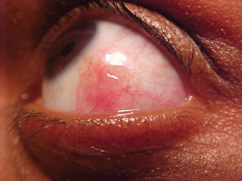 This 22-year-old patient had been experiencing eye pain for about a week. In addition to her history, can this photo help you uncover the cause of her discomfort?