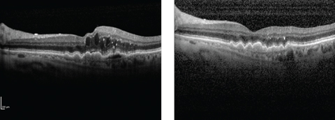 Wet AMD patient before (left) and after (right) treatment with Lucentis. The PDS hopes to maintain clinical improvements of this kind while reducing the treatment burden.