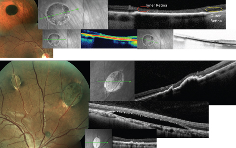 Fig. 5. The top images show typical CHRPE lesion with associated typical OCT findings: thickening and hyperreflectance of the RPE, atrophy of the outer retina with sinking or caving of the inner retina and reduced reflectance of the choroid. The bottom images show typical RPEH-FAP lesions, as well as the variable OCT presentations.