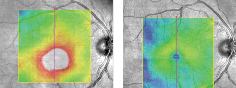 Figs. 1 and 2. This patient’s center-involved DME (left) responded well to anti-VEGF (right).