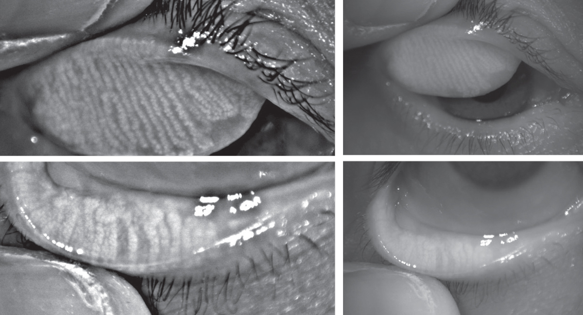 Infrared images of the upper and lower eyelids with non-invasive meibography shows healthy, long meibomian glands.