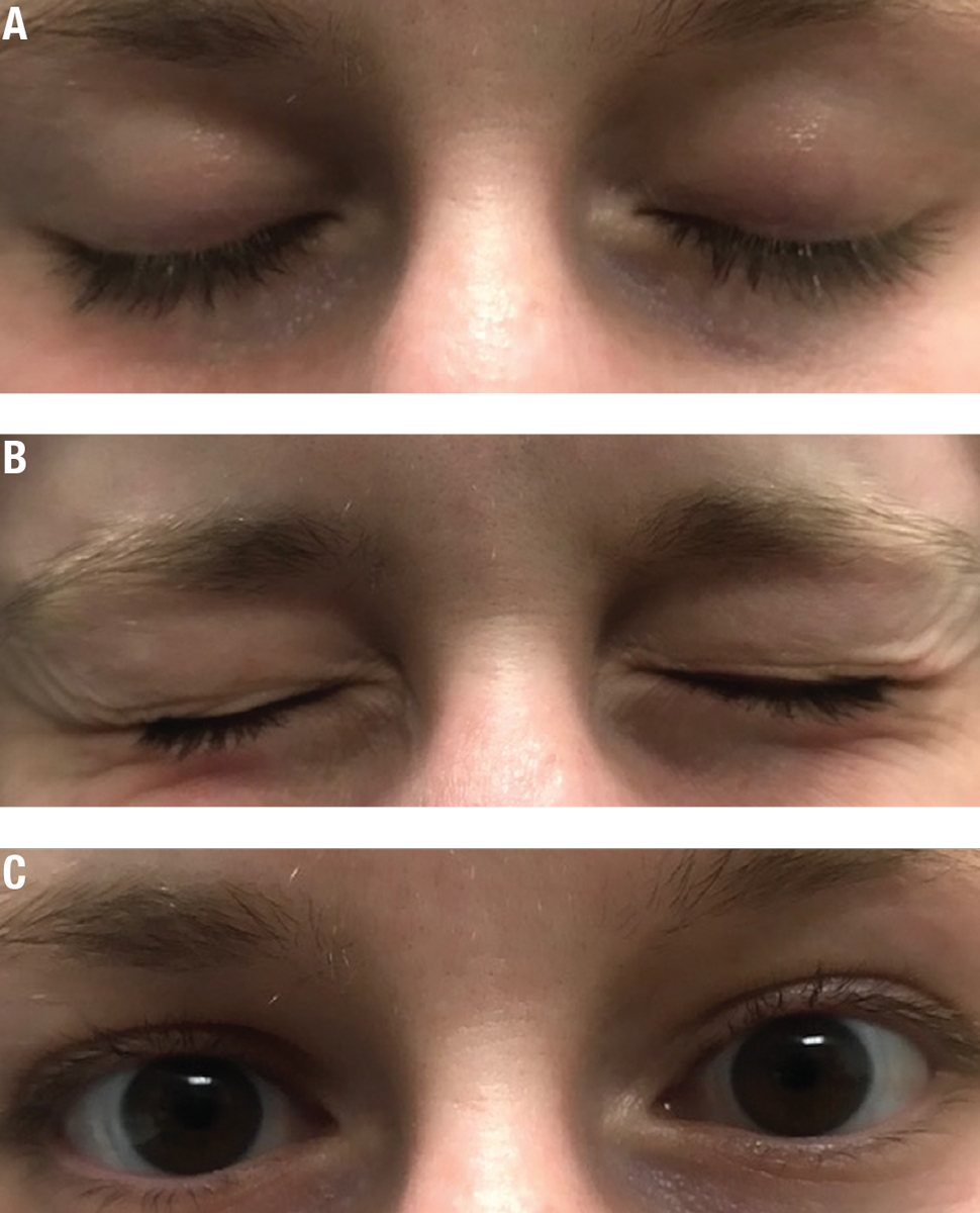 Fig. 1. Blinking exercises will help make proper complete blinking a habit. The blink sequence: (A) Close normally for a count of two and open. Close normally for a count of two again. (B) Squeeze the eyelids together for a count of two. (C) Open to complete the blink sequence.