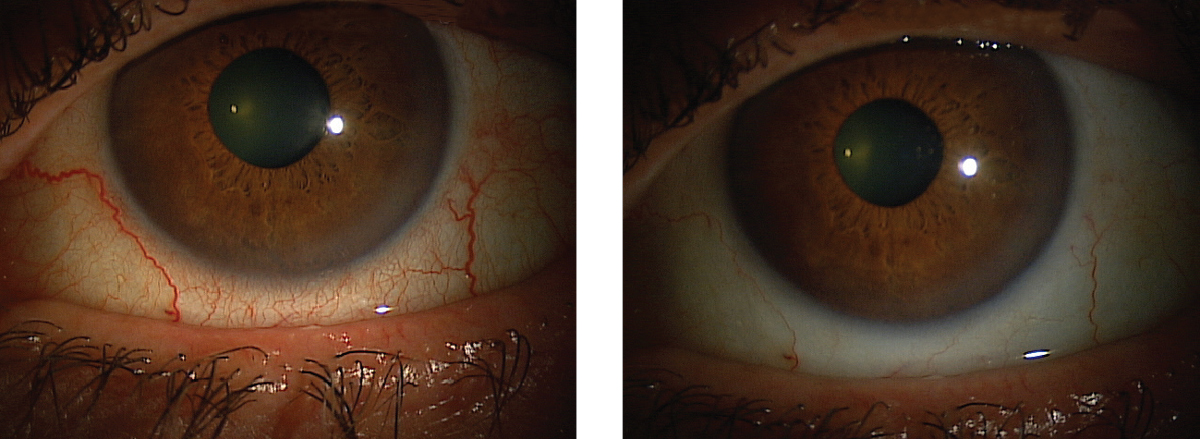 This patient’s red eyes cleared up after instilling Lumify, and they can expect the effects to last six to eight hours.