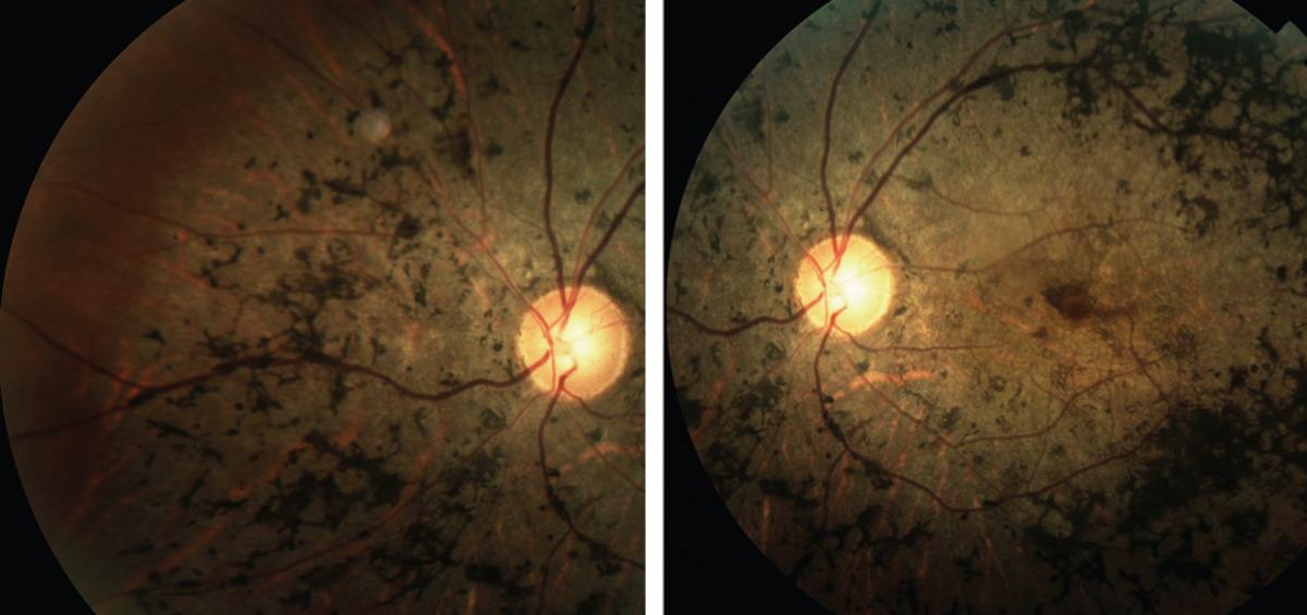 Fig. 2. These images depict the classic presentation of syphilitic retinopathy.