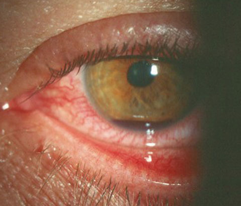 Hyphema, seen here, is common after athletic injury or other trauma.