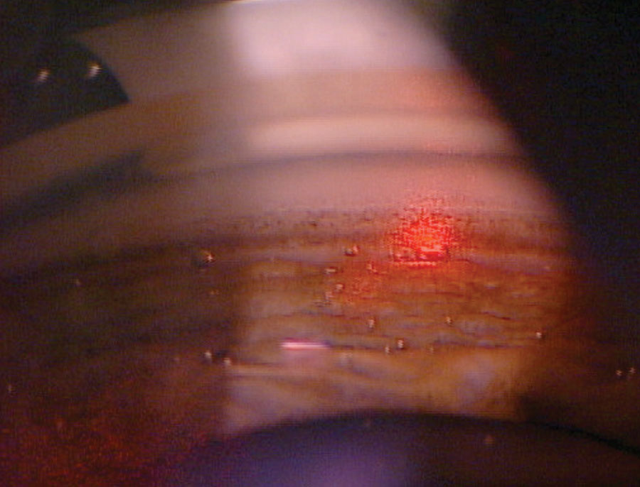 The cavitation or “champagne” bubbles that can be seen throughout the TM during SLT lets the surgeon know the laser is properly interacting with the tissue.