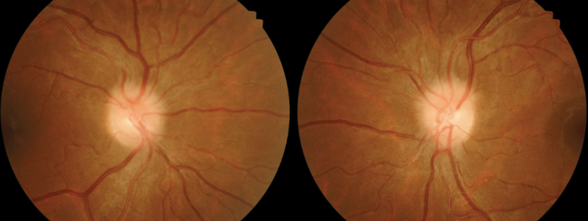 Fig. 1. Fundus photos from January 2016. Note the blurred disc margins.