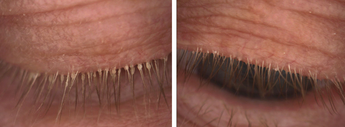 Fig. 3. This patient, seen here before (at left) and after treatment, experienced significant improvement in signs and symptoms of Demodex infestation with four months of tea tree oil foam cleanser QHS.