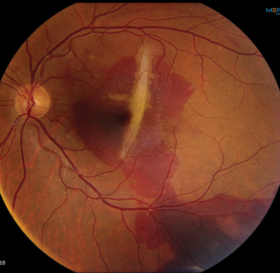 Fig. 3. This fundus photo shows our patient two weeks later. What do you see now?