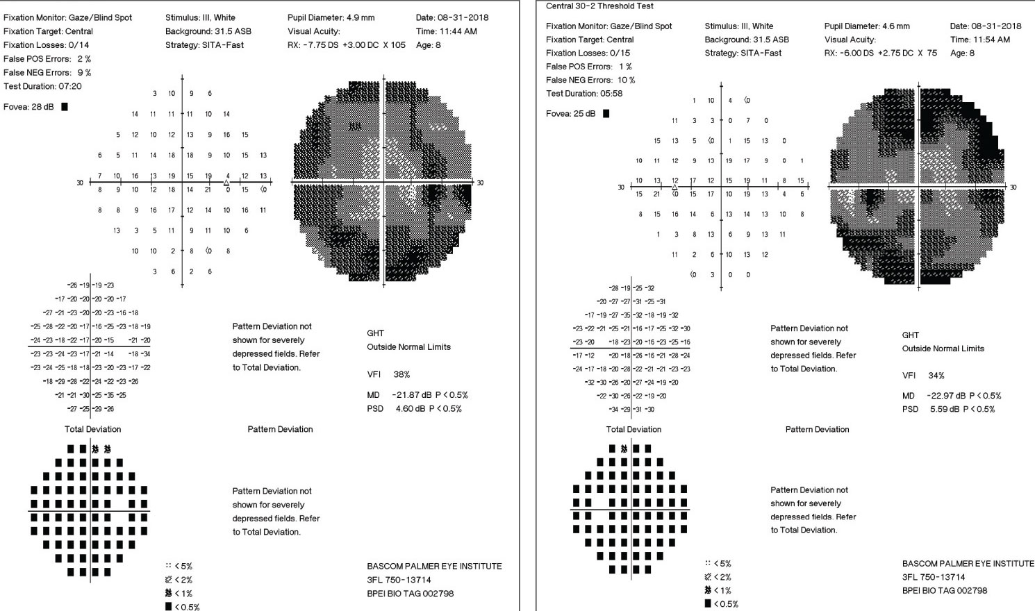 These 30-2 visual fields showing significant loss of the peripheral fields in each eye.