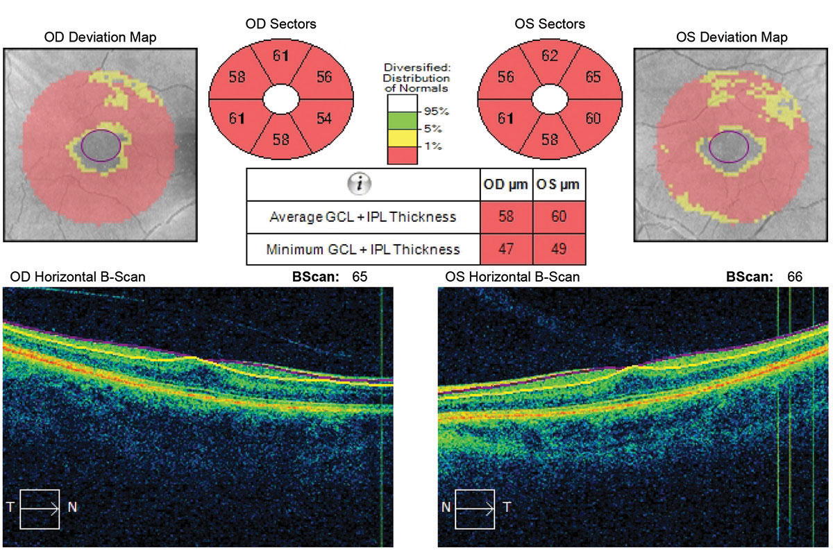 Ganglion cell analysis revealed a reverse foveal pit and no vitreal macular traction.