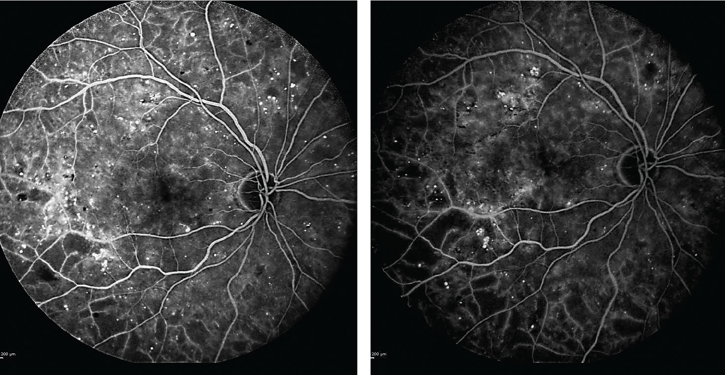 Fig. 2. After beginning anti-VEGF treatments, the patient’s subsequent fluorescein angiograms at one and two years into the regimen (left and right images, respectively) confirmed no progression of ischemia or evidence of proliferative diabetic retinopathy.