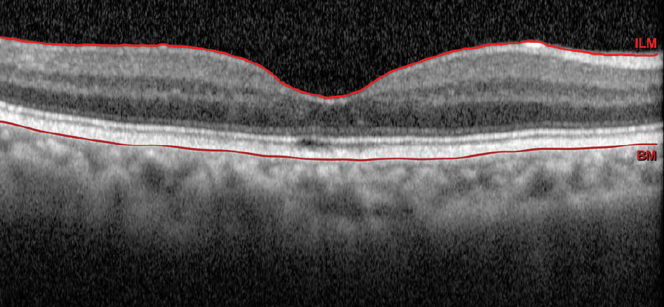 Fig. 2. OCT of our patient’s right eye. 