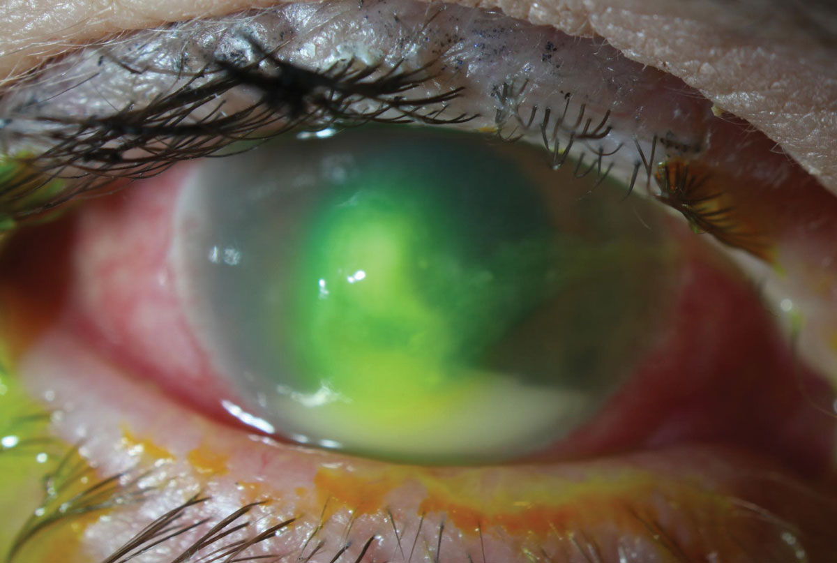 Pseudomonas aeruginosa is one of the leading causes of contact lens–related MK.