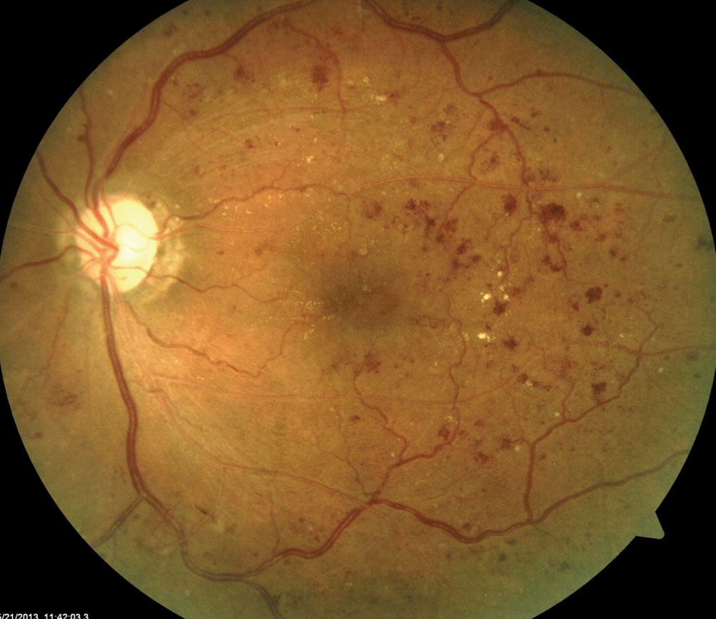 Fig. 1. This fundus shot shows a patient with signs of moderately severe NPDR.