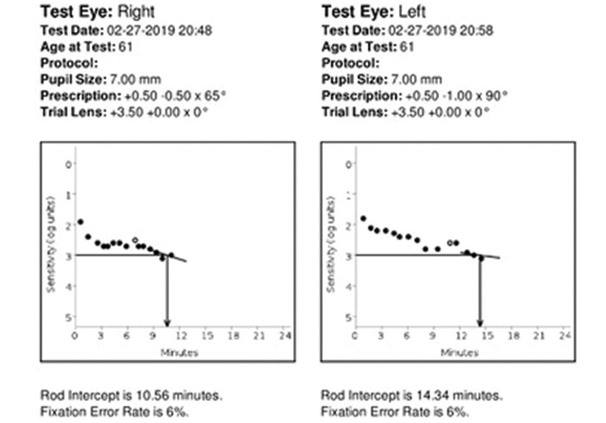 The patient’s rod intercept time is statistically significant abnormal more so in the left eye than the right, at 10.56 minutes OD and 14.34 minutes OS. The rod intercept time is normal if the test is completed in less than 6.5 minutes, which accounts for the normal age increase for dark adaptation. After ruling out the other possible diagnoses that cause delayed dark adaptation for this patient’s case, the diagnosis was definitively made as AMD with functional deterioration of dark adaptation.
