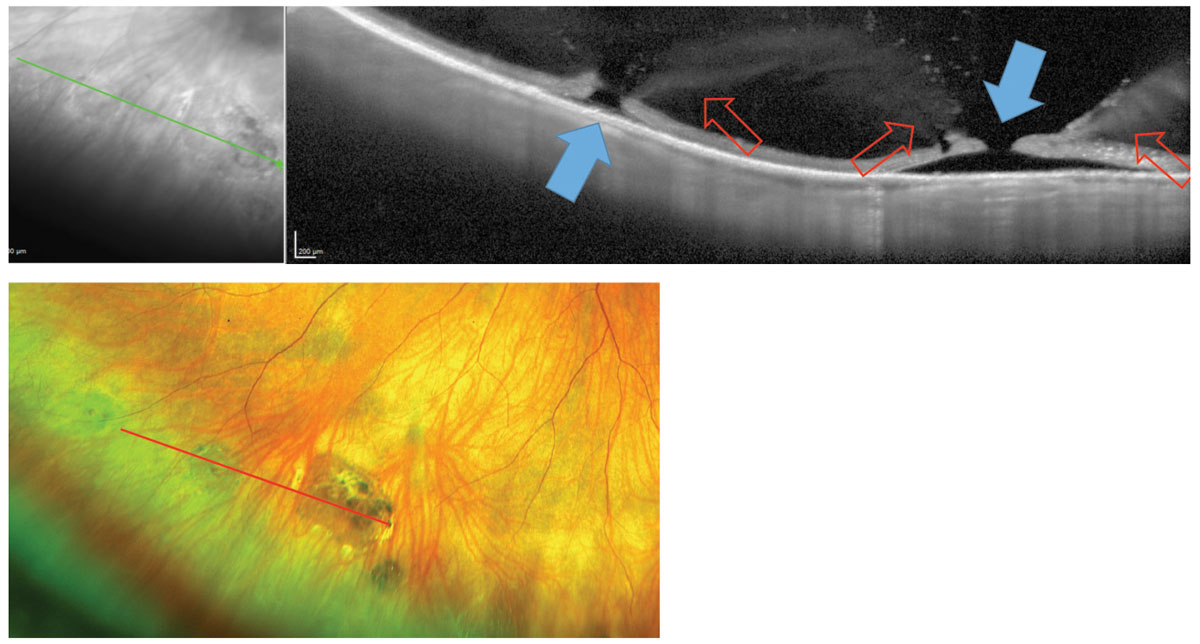 Fig. 2. The above images display atrophic retinal holes (blue arrows) with surrounding regions of vitreoretinal adhesion (red arrows) visible in the images above and also at left.