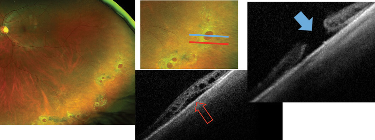 Fig. 3. Lattice degeneration with multiple retinal holes. OCT shows a full-thickness break (blue arrow) and surrounding sub-and intraretinal fluid (red arrow) in the so called “cuff of fluid.” The progression of this fluid can lead to a chronically progressive rhegmatogenous retinal detachment.