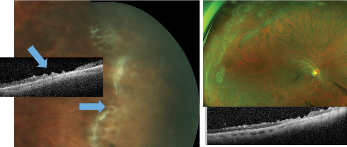 Fig. 4. The small crevices (blue arrow) noted within patches of lattice usually represent a partial excavation of the neurosensory retina. As these can be considered “partial-thickness holes,” there is no threat for chronic flux of fluid to the subretinal space. Careful examination and scleral depression is needed to distinguish between full-thickness and partial-thickness retinal holes, as their management can vary. OCT can help make the distinction.