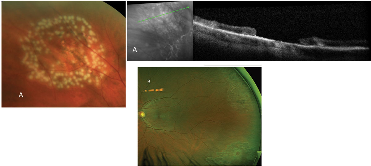 Fig. 6. Laser prophylaxis is noted around a single atrophic hole (previously noted in Figure 1A) and multiple holes (noted in Figure 3B). Here, in (A), you can see blanching of the laser immediately after application, while in (B) a typical hyperpigmentation  is noted with time. 