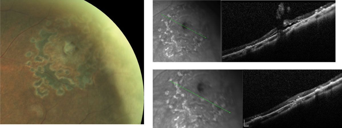 Fig. 11. The patient in Figure 8B is shown here following prophylactic laser treatment. The partial resolution of the fluid cuff is noted while progression to retinal detachment is avoided.