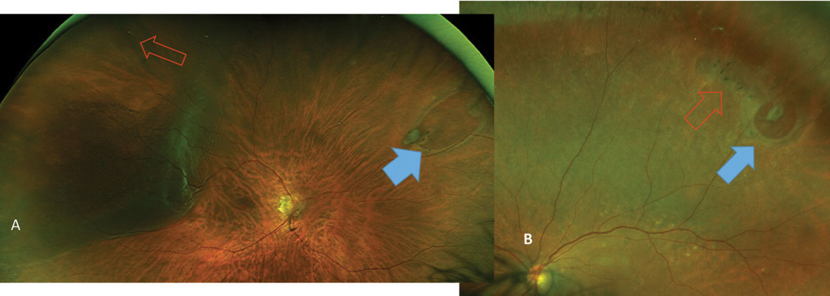 Fig. 12. Image (A) reveals HSRT (blue arrow) with no associated symptom or retinal detachment; however, a small retinal hole (red arrow) has resulted in a slowly progressing retinal detachment, causing a slow-moving shadow in the patient’s peripheral vision. In (B), a horseshoe retinal break (blue arrow) associated with lattice degeneration (red arrow) is seen in an asymptomatic patient.