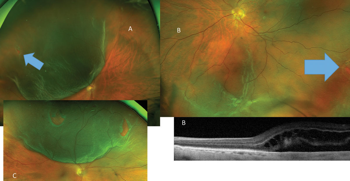 Fig. 13. Following PVD symptoms this patient (A) developed a superotemporal RRD caused by a small HSRT (blue arrow), while another patient (B) has developed an inferior macula off RRD from HSRT (blue arrow). These patients required surgical intervention. The RRD in (C) is caused by more than one retinal tear, not an uncommon finding.