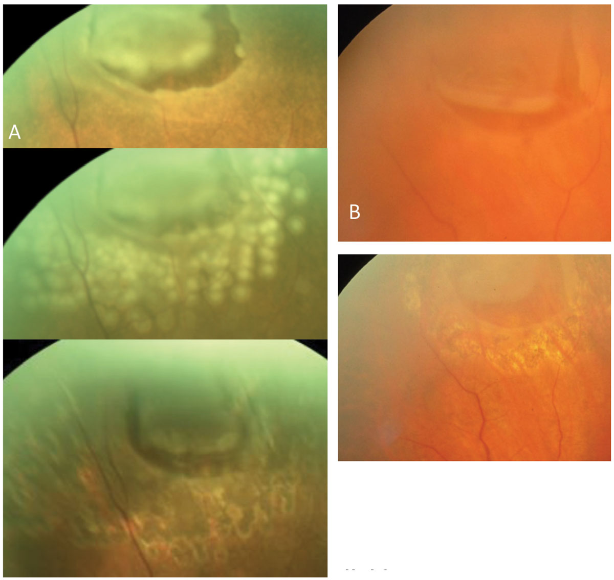 Fig. 14. Far left, horseshoe tears without retinal detachment (A) are treated with laser. The immediate and long-term of effect of laser (B) is shown, while in long-term hyperpigmentation.