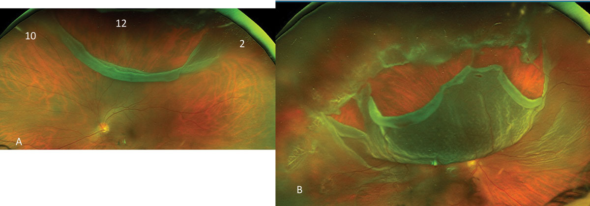 Fig. 15. This more-than-three-clock-hour wide retinal break (A) with limited retinal detachment is seen, while (B) shows a near total RRD.