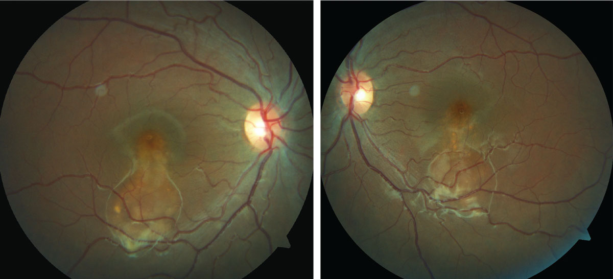 This 16-year-old presented for a routine exam, but an evaluation of her fundus revealed something amiss. Can you identify it?