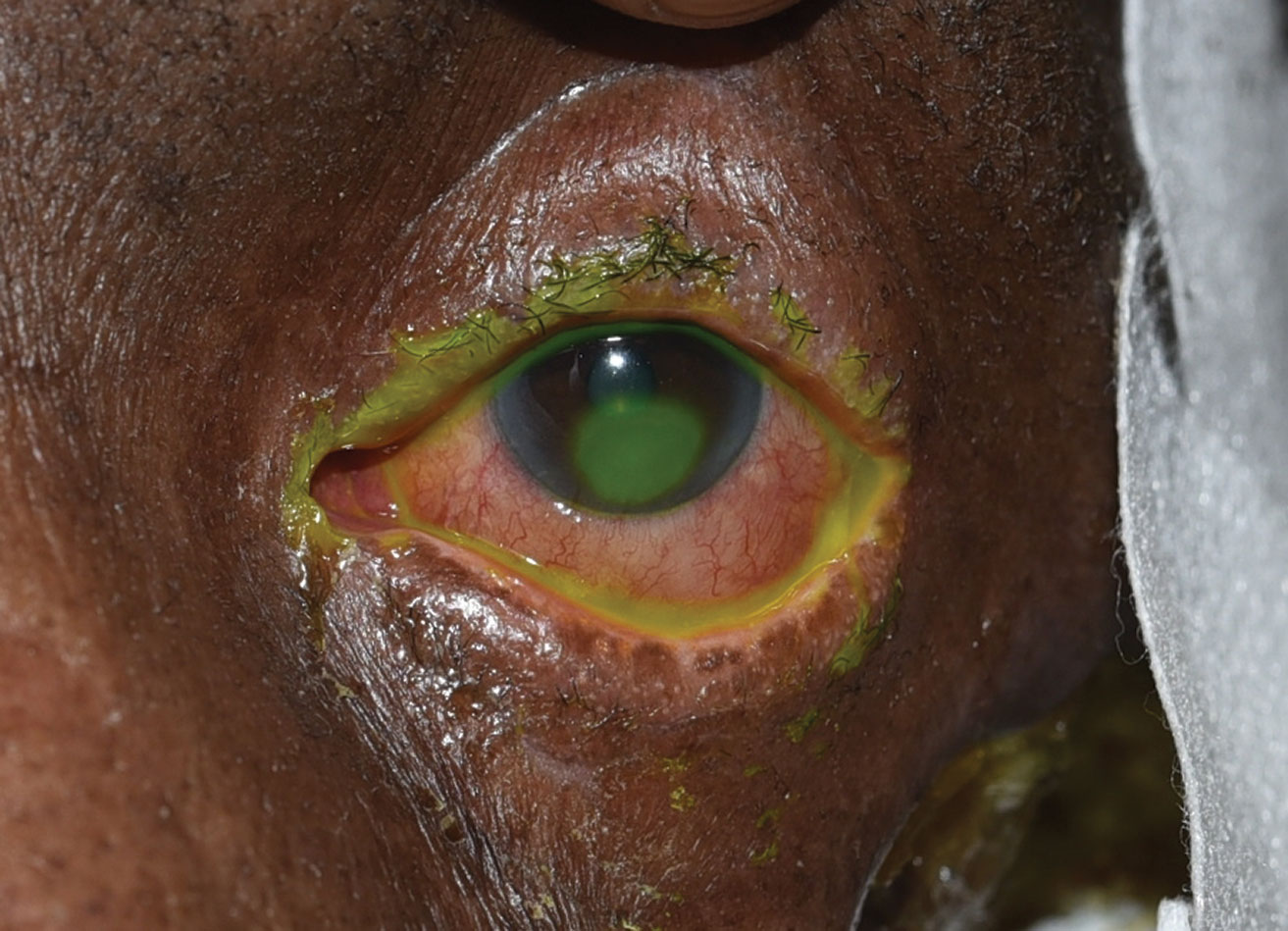 This patient displays an inferior corneal epithelial defect seen in neurotrophic keratopathy.