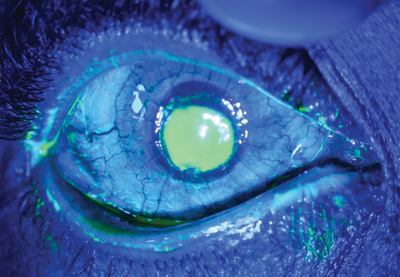 This patient with neurotrophic keratitis underwent penetrating keratoplasty. Here, they’re seen before plasma rich in growth factor eye drop application.