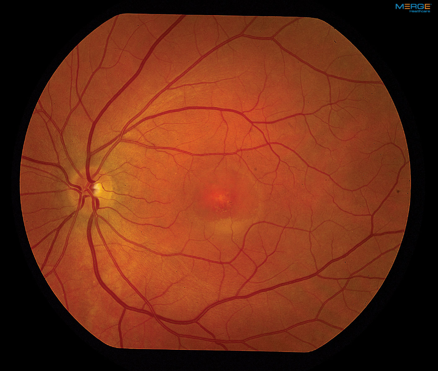 An 18-year-old man with dominant optic atrophy (DOA). The fundus
