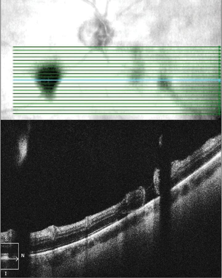 Fig. 4. OCT raster scan reveals a subclinical retinal tear with minimal surrounding subretinal fluid in a patient with acute onset vitreous hemorrhage and proliferative DR. 