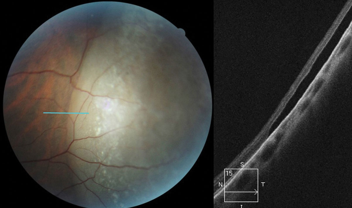 Fig. 5. OCT raster scan taken though an elevated peripheral retinal region in a 26-year-old female diagnosed with retinoschisis one year prior. OCT reveals a full-thickness RRD caused by a combination of inner and outer layer holes in a preexisting retinoschisis. 