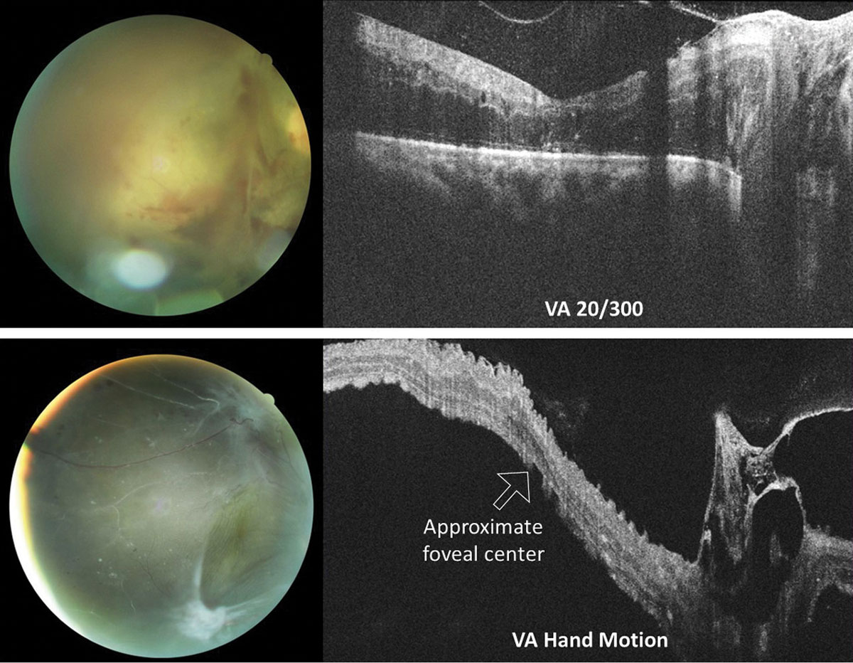 Fig. 7. OCT raster scans through the optic nerve and macula in two different patients with proliferative diabetic retinopathy with vitreoretinal traction of the right eye. In both instances, macular involvement was uncertain based on clinical examination alone. The top eye suffers from severe macular edema of an attached macula. Conversely, the macula of the bottom eye is detached. Acuities were top 20/300 (top) and hand motion (bottom). 