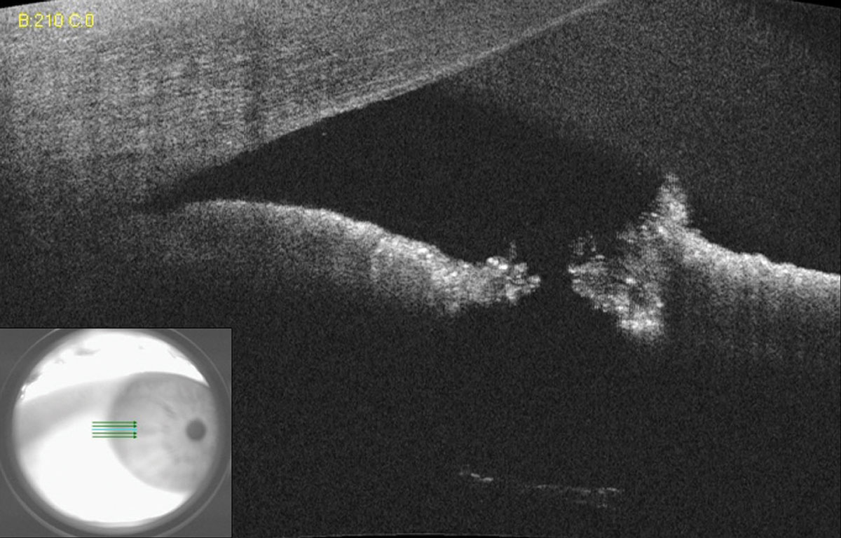 Fig. 10. AS-OCT of a small laser peripheral iridotomy reveals a full thickness hole. Lens zonules can be seen in the bottom scan due to light penetration through the patent iridotomy. 