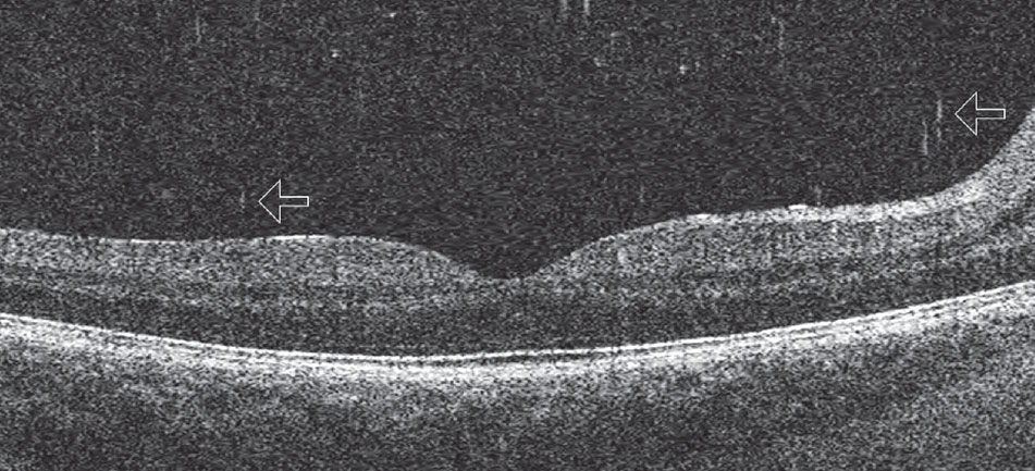Fig. 8. This posterior Shaffer’s sign shows cells in the posterior vitreous that appear as “falling ash” (arrows). 