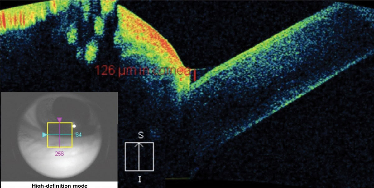 Fig. 12. The crosshair of this anterior segment cube scan taken at the lid margin shows the tear meniscus height at the fornix of the globe and the palpebral conjunctiva. The measurement of 126μm is considered dry eye.