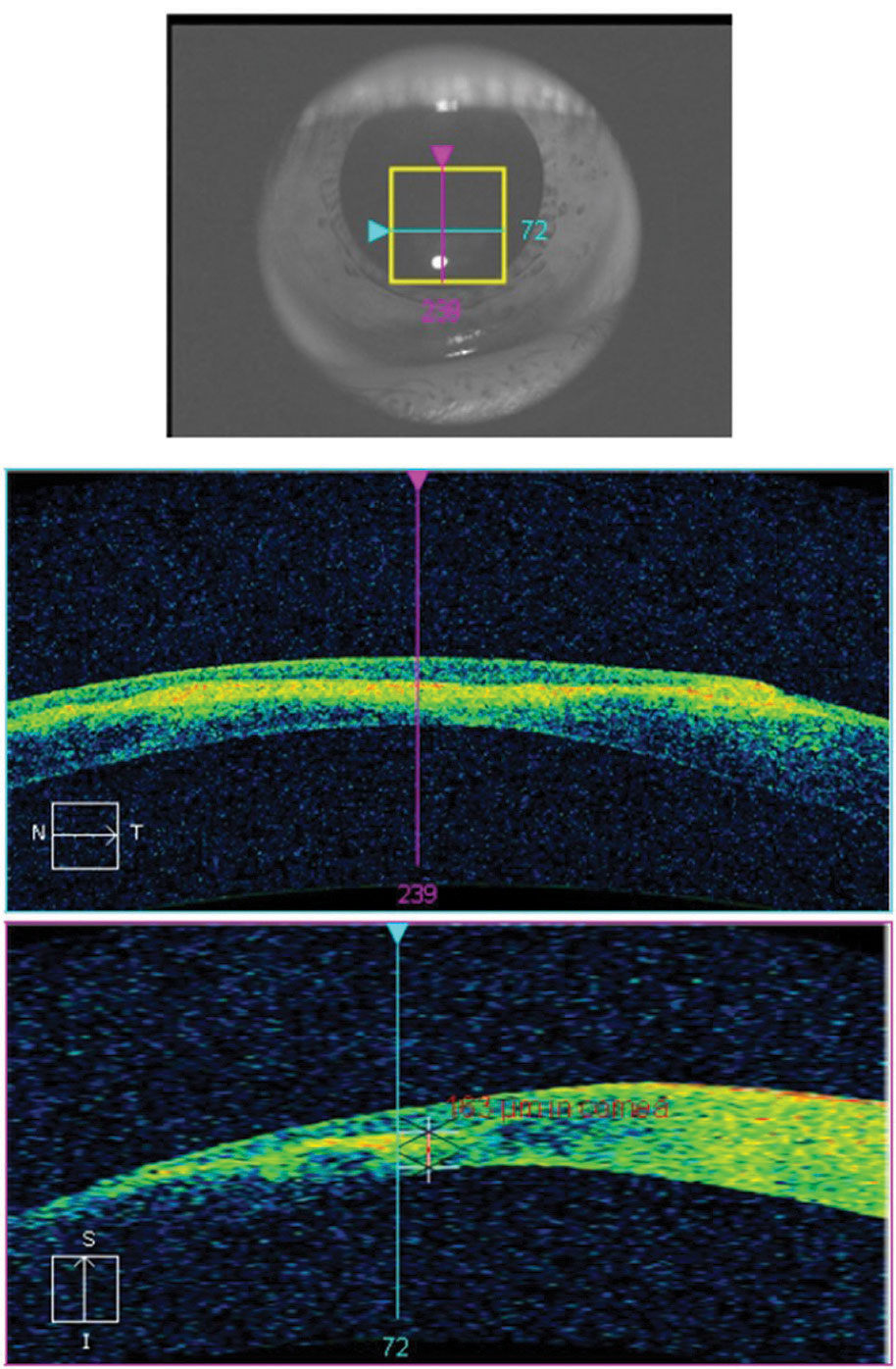 Fig. 11. This AS-OCT scan of a 28-year-old Asian patient with advanced keratoconus and moderate-to-severe pain demonstrates intact endothelial and posterior stromal layers while showing increased reflectivity associated with stromal scarring. In this case, AS-OCT confirmed an intact endothelium and Descemet’s membrane. As an added advantage, corneal thickness was measured accurately at the thinnest location using the caliper tool, thereby providing a reliable baseline for follow-up comparison. In light of the anatomical state of the cornea, the patient’s symptoms were attributed to epithelial disruption overlying the apex of corneal steepening. 