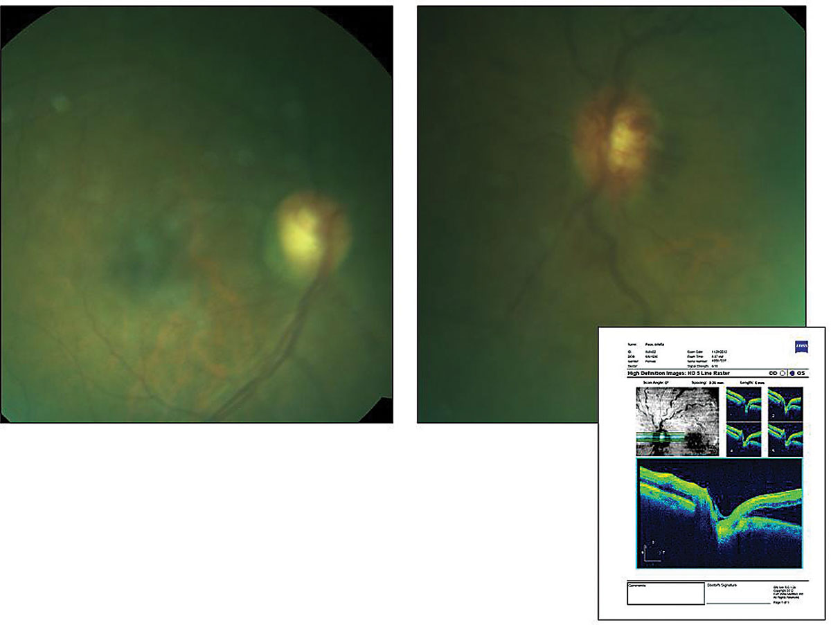This 67-year-old patient has a history of open-angle glaucoma and an uncomplicated non-ischemic central vein occlusion. She also had hypertension, diabetes and dyslipidemia. Does this presentation plus her history help identify the cause of her reduced visual clarity?