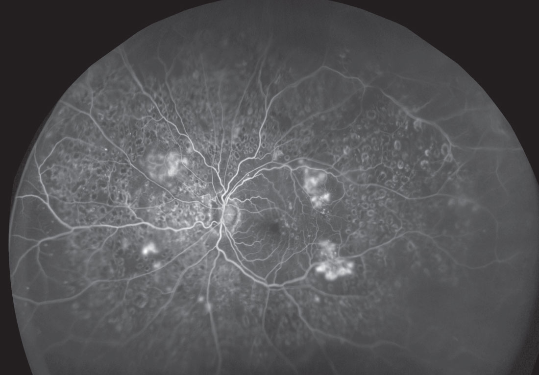 This ultra-widefield image shows an expansive view of a retina with severe diabetic retinopathy.