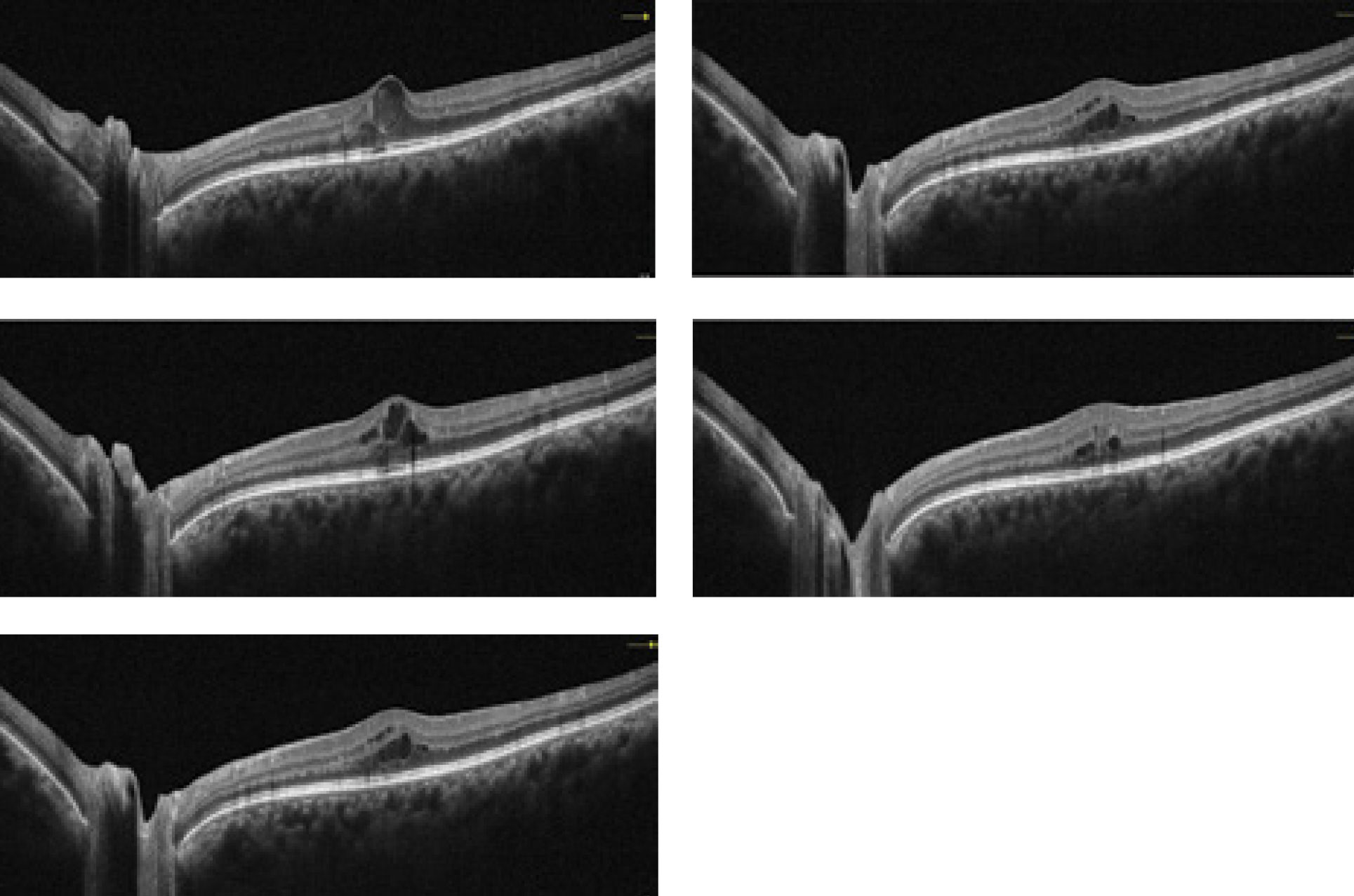 This collection of OCT images exemplify how the technology is able to portray a diabetic retinopathy patient through the course of several visits.