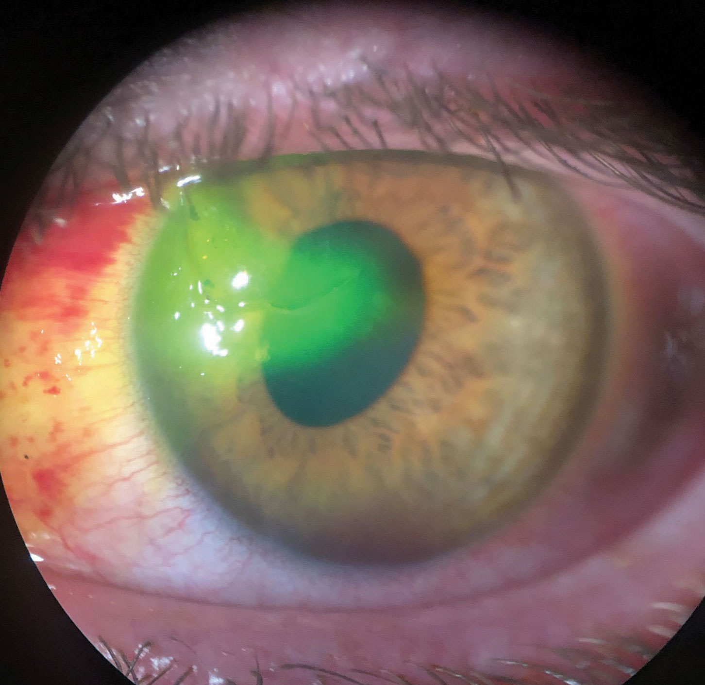 This patient suffered a traumatic corneal laceration after a mishap with a screwdriver. Note the sodium fluorescein being pulled into the stroma and the oblong pupil.
