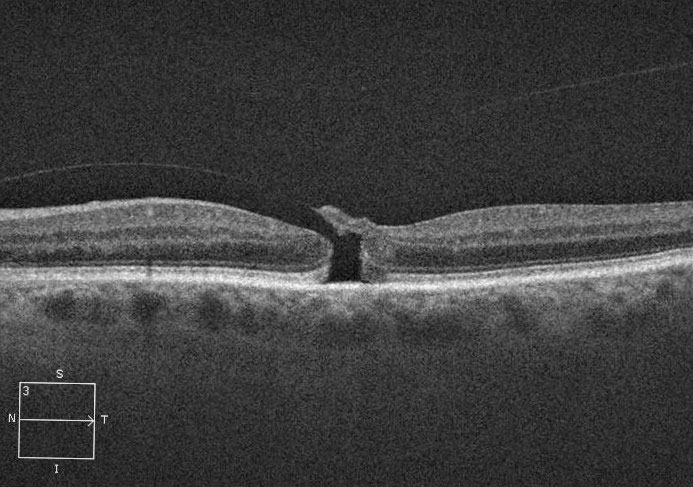 Fig. 2. This stage 2 macular hole has an attached posterior hyaloid.