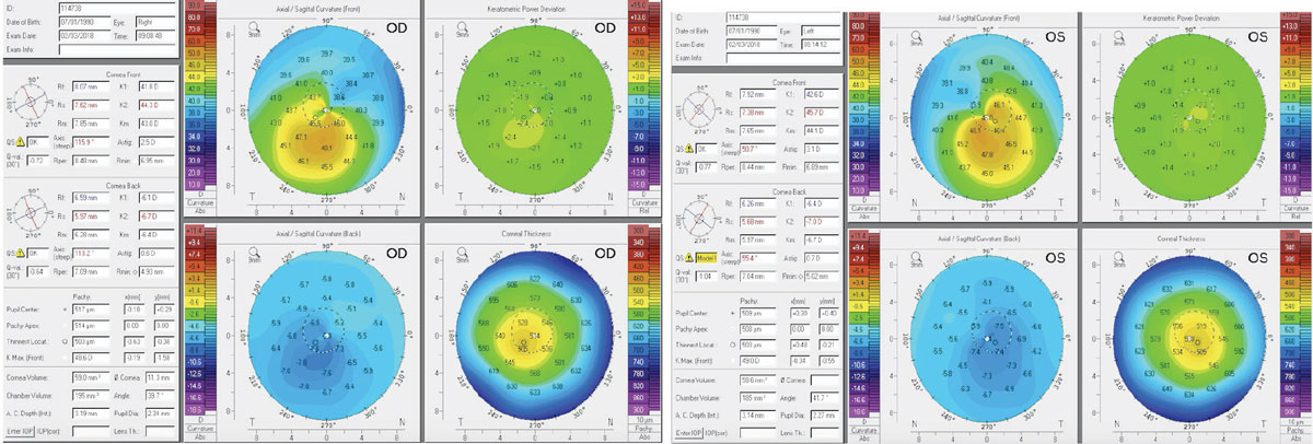 Figs. 1 and 2. Above, these corneal topography scans show a patient with subclinical keratoconus. The patient here was refractable to 20/20 but complained of excessive glare and halos.  Note the inferior steepening and the thin central corneal thickness.